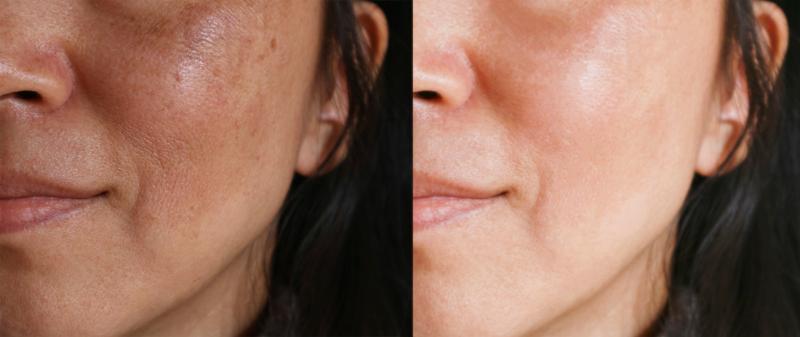 Close-up of a woman’s face showing before and after results of IPL skin treatment.