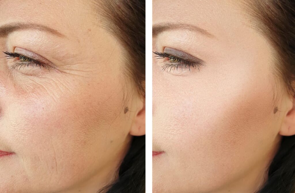 A side-by-side comparison of a woman's face before and after Xeomin treatment.