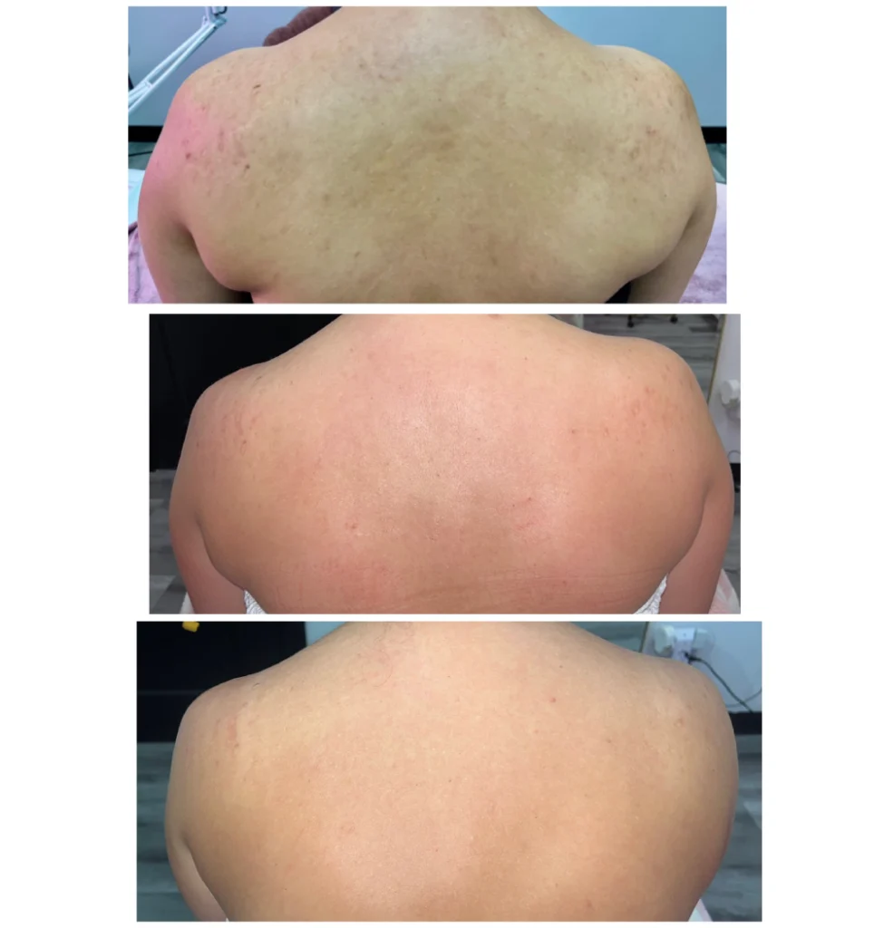 Back acne scar treatment results showing reduced scarring, redness, and smoother skin texture