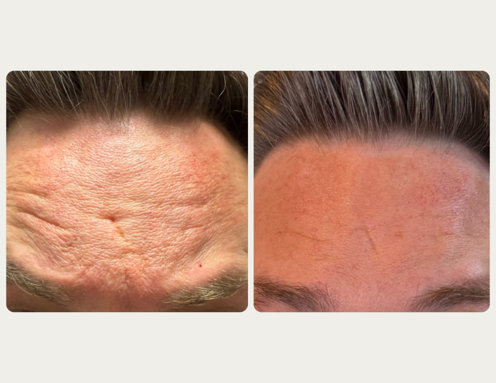 Daxxify before and after forehead wrinkle treatment